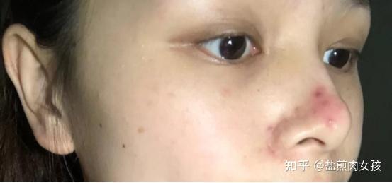 有酒糟鼻的明星,勇敢面对肌肤挑战的美丽传奇