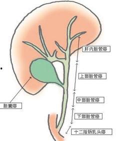 胆管癌明星,探索新型治疗策略与突破